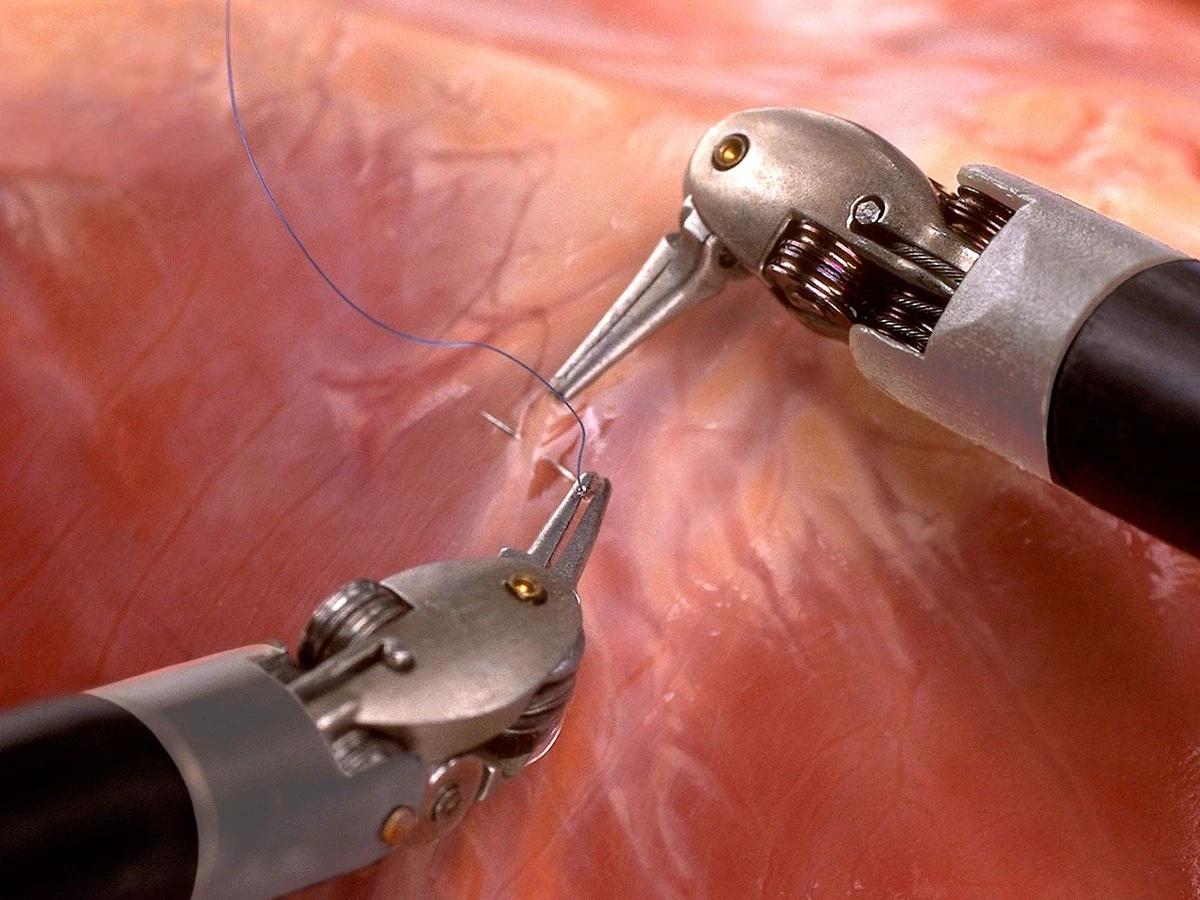 Het geheim achter operaties met een robot: waarom artsen plotseling 3 meter diep kijken - image 2